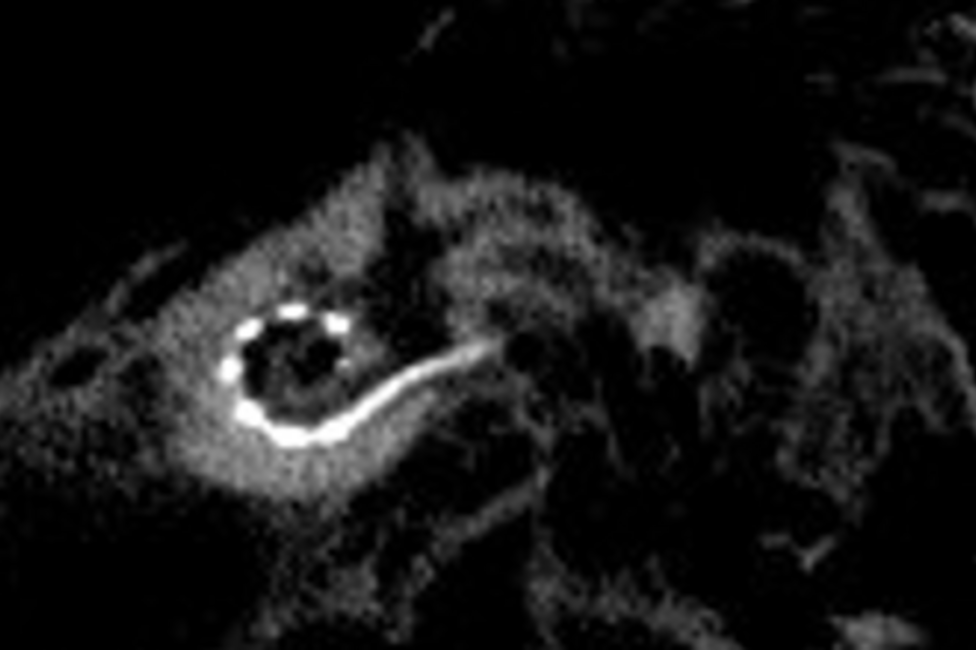 Intraoperatives DVT zur Elektrodenkontrolle