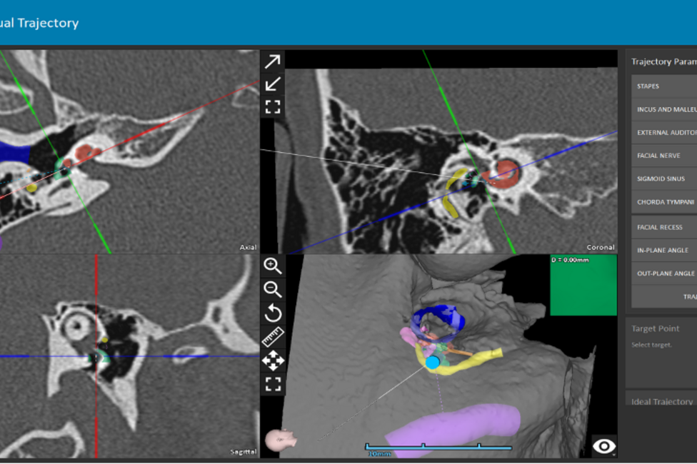 Präoperative OP-Planung mit OTOPLAN